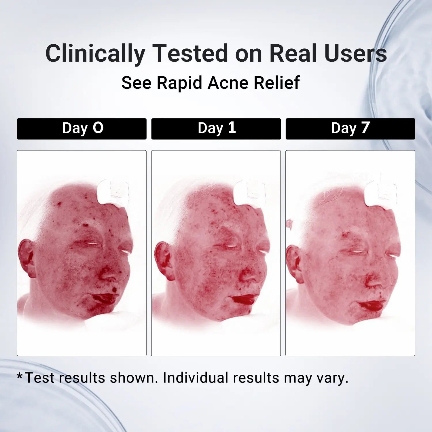Dr.Leo Drying Lotion | Pimple Treatment & Body Acne Treatment 